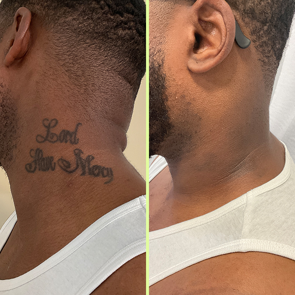 Laser tattoo removal