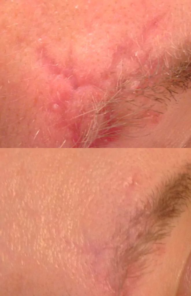 Scar removal - result after 1 procedure
