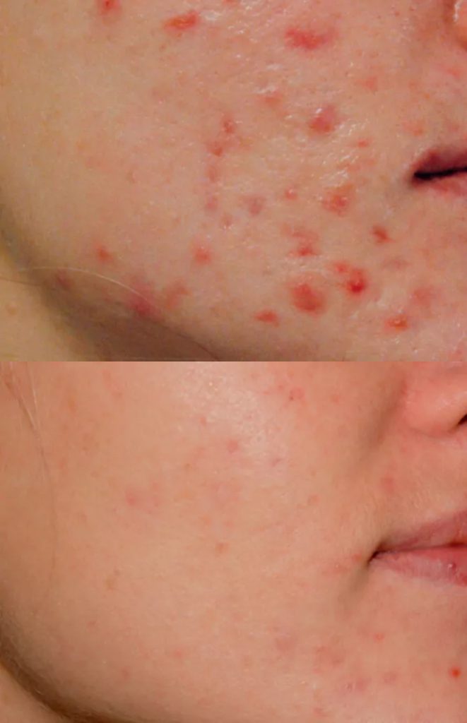 Acne - result after 3 procedures
