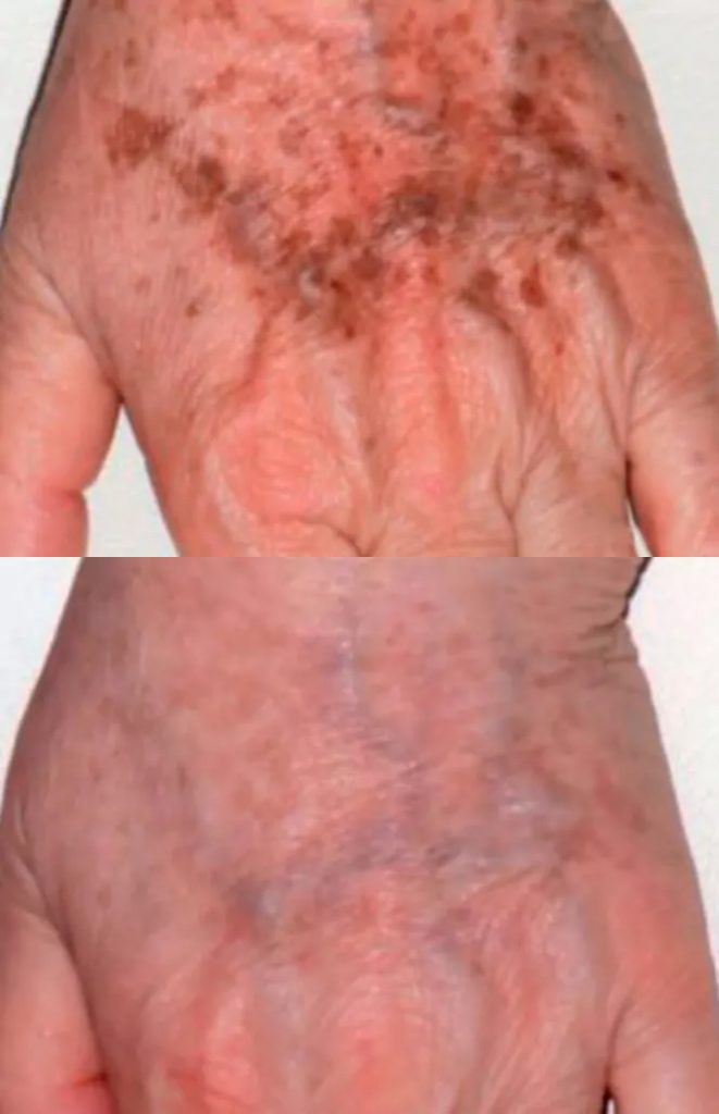 Pigment spots - result after 3 procedures