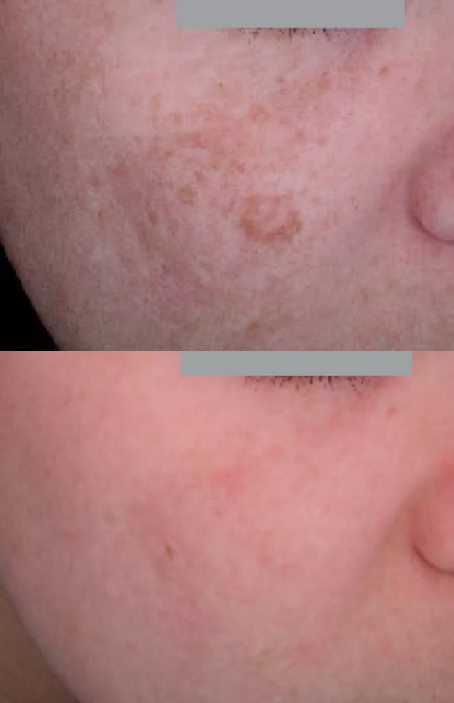 Pigment spots - result after 1 procedure