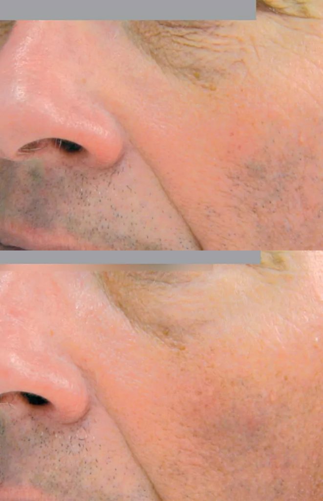 Rejuvenation - result after 3 procedures