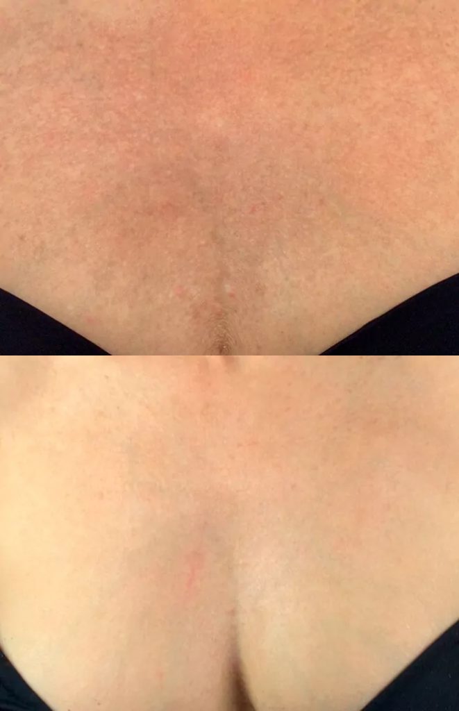 Rejuvenation - result after 1 procedure
