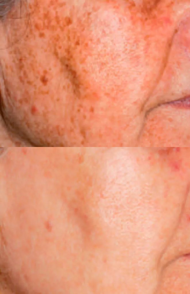 Rejuvenation - result after 3 procedures