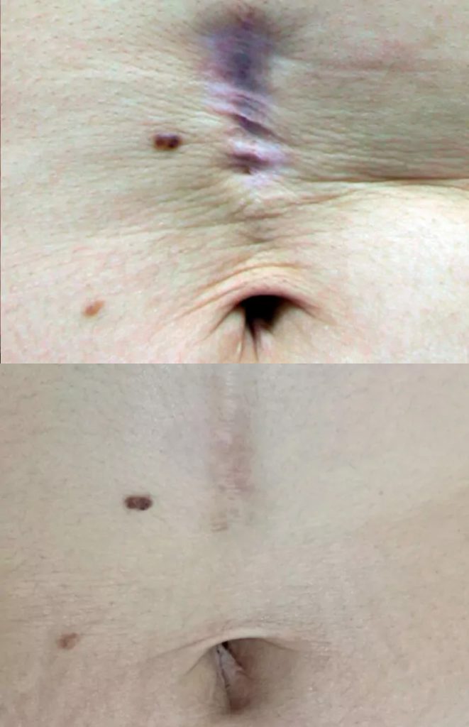 Scar removal - result after 3 procedures