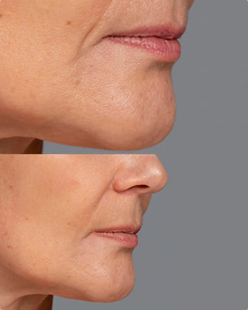 Face lifting