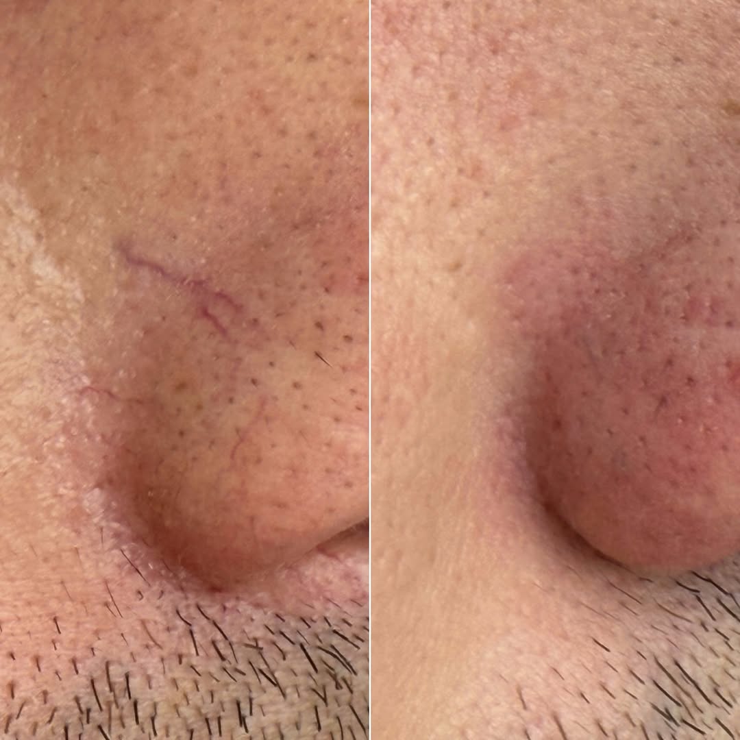 Removing-Veins-and-Rosacea-with-the-Nordlys-Laser-from-Candela