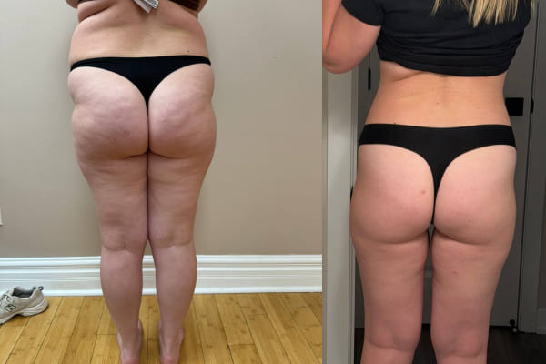 Result after 4 months