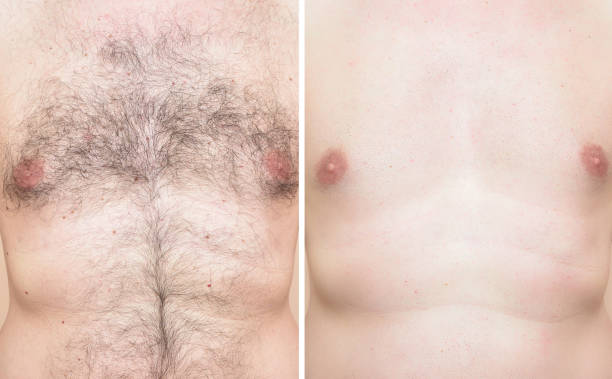 Laser Hair Removal